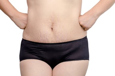 stretchmarks karnı üzerinde gösterilen kadın