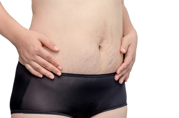 stretchmarks karnı üzerinde gösterilen kadın