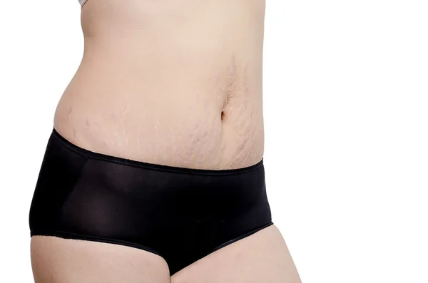 Woman showing stretchmarks on her belly — Stock Photo, Image