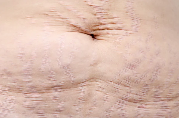 Stretch marks on Asian woman belly — Stock Photo, Image