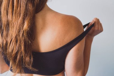 Güneşe maruz kalma ve güneş kremi kullanma kavramı, omuzlarında yoğun yanık izleri olan bir kız.