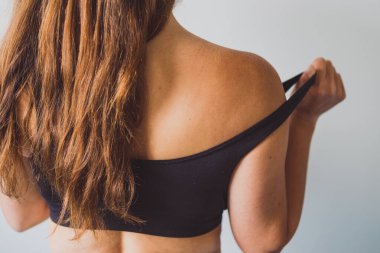 Güneşe maruz kalma ve güneş kremi kullanma kavramı, omuzlarında yoğun yanık izleri olan bir kız.