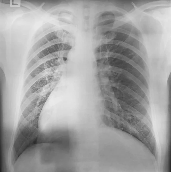 Corona Virus Infection Closeup Photo Ray Human Lungs Human Chest — Stock Photo, Image