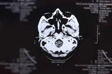 images from a computerized tomography of the brain clipart