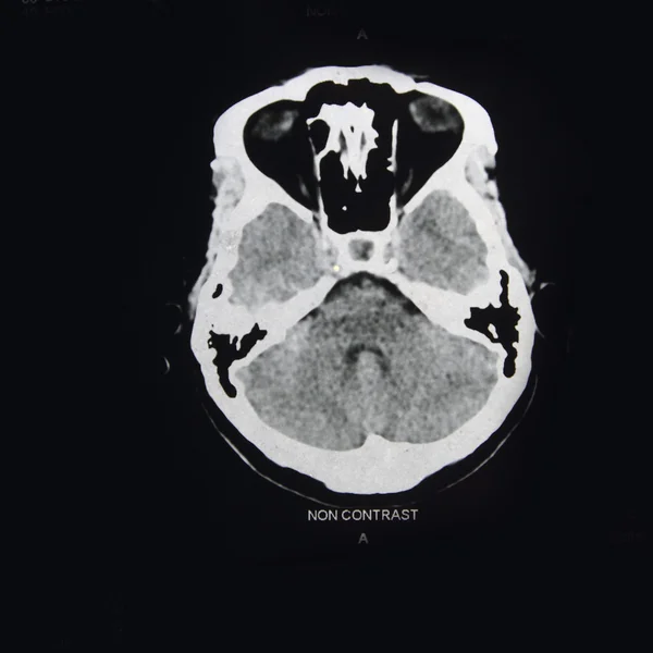 Imagens de uma tomografia computadorizada do cérebro — Fotografia de Stock