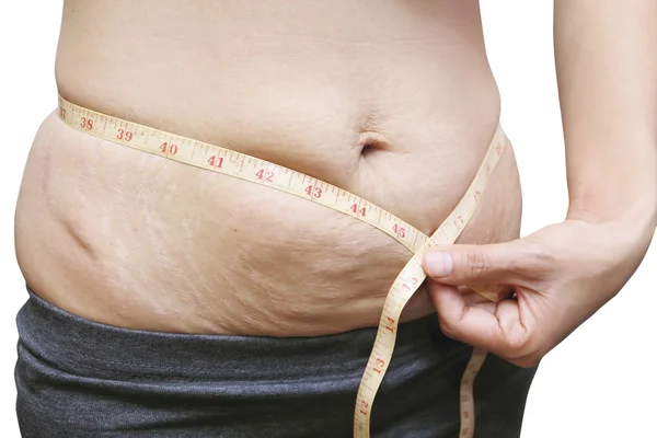 Stretch marks on Asian woman belly — Stock Photo, Image