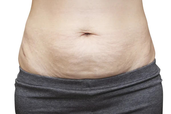 Asyalı kadın göbek üzerinde streç işaretleri