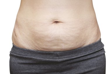 Asyalı kadın göbek üzerinde streç işaretleri