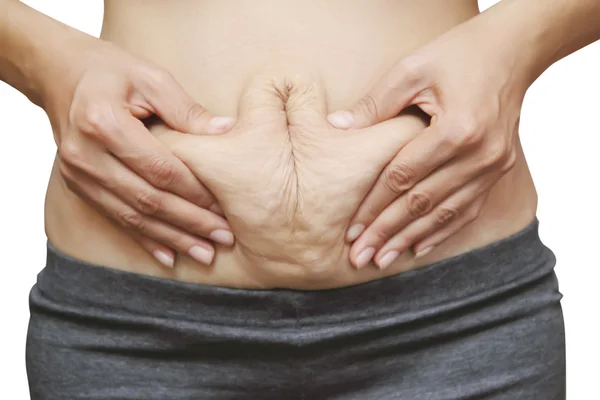 Stretch marks on Asian woman belly — Stock Photo, Image