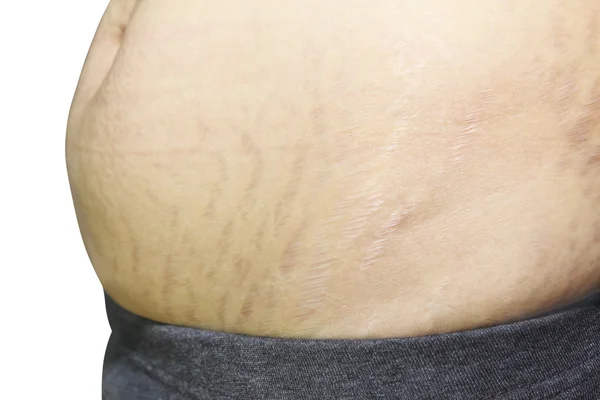 Asyalı kadın göbek üzerinde streç işaretleri