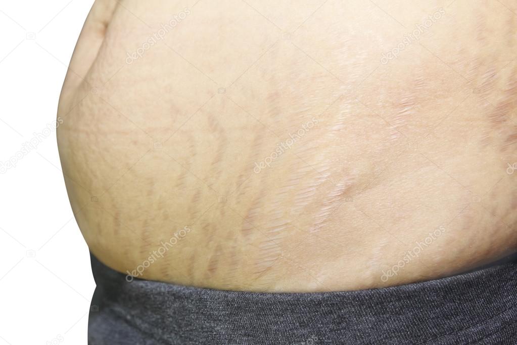 stretch marks on Asian woman belly