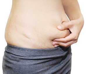 Asyalı kadın göbek üzerinde streç işaretleri