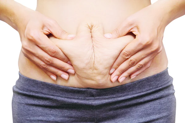 Asyalı kadın göbek üzerinde streç işaretleri