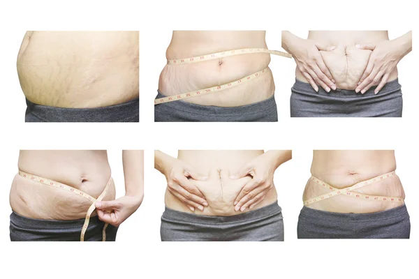 Asyalı kadın göbek üzerinde streç işaretleri