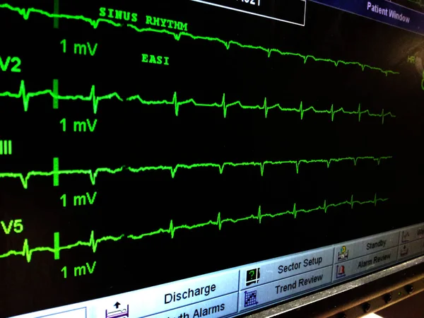 Többszörös zöld EKG követés az intenzíven — Stock Fotó