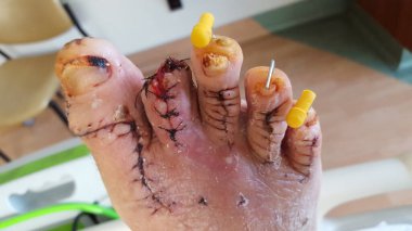 Travmayı takiben sağ ayağında çivi yaraları var.