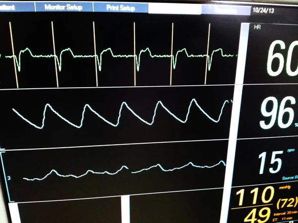 Intenzív monitor képernyő mutatja Pacemaker tüskék a felső nyomon követés — Stock Fotó