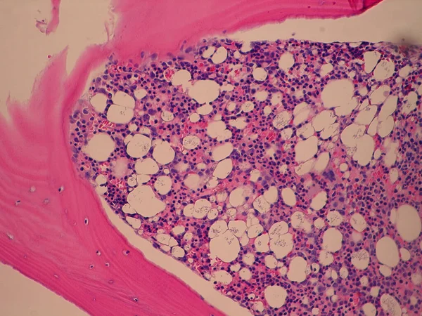 Patologia da biopsia do núcleo da medula óssea - infeção disseminada por Histoplasma — Fotografia de Stock
