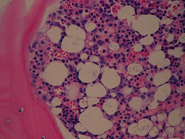 Patología de la biopsia de médula ósea - Infección diseminada por histoplasma —  Fotos de Stock