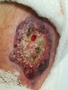 Ülseratif kolit hastası bacağında Pyoderma gangrenosum var.