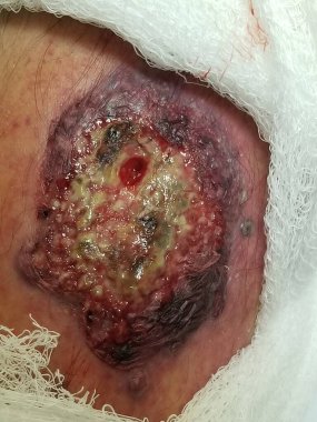 Ülseratif kolit hastası bacağında Pyoderma gangrenosum var.