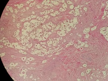Crytpococcus neoformans akciğer biyopsisinde hematoksin ve eozin ile lekelenmiş.