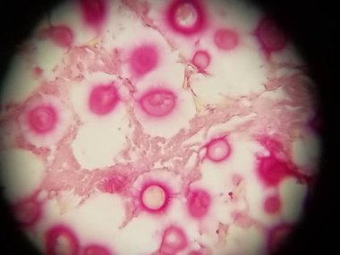 Crytpococcus neoformans akciğer biyopsisinde mukiçarmin ile lekelenmiş.