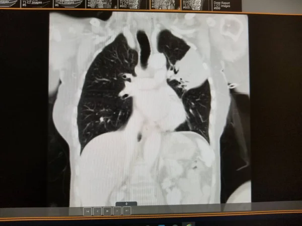 左上葉肺炎クリプトコッカス新生物 — ストック写真