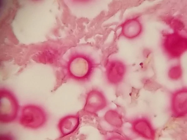 Crytpococcus neoformans coloré à la mucicarmine lors d'une biopsie pulmonaire — Photo