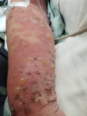 Hastaların ön kollarında boğa gibi pemphigoid deri lezyonları.