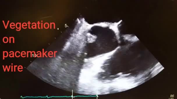 Vegetatie op geïnfecteerde pacemaker draad - endocarditis patiënt — Stockvideo