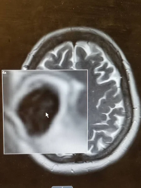 Brain CT with Cysticercosis - Larva of Pork Tapeworm — Stock Photo, Image