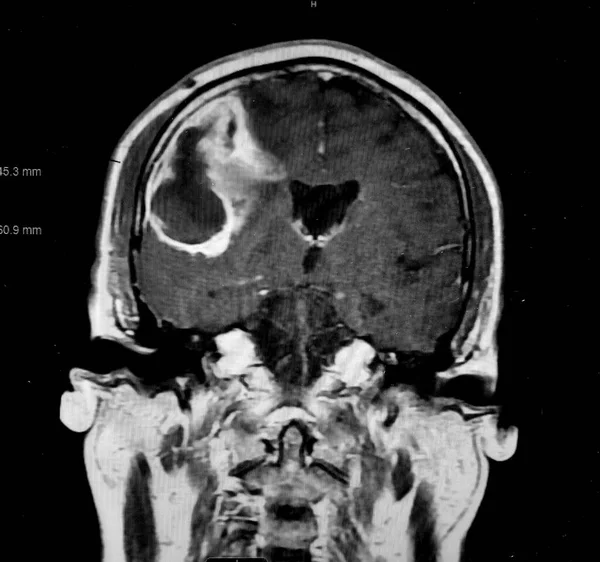 Mozek CT ukazuje E. coli Mozek Absces — Stock fotografie