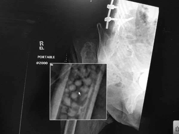 Perline antibiotiche all'interno del femore dopo la rimozione dell'anca protesica infetta — Foto Stock