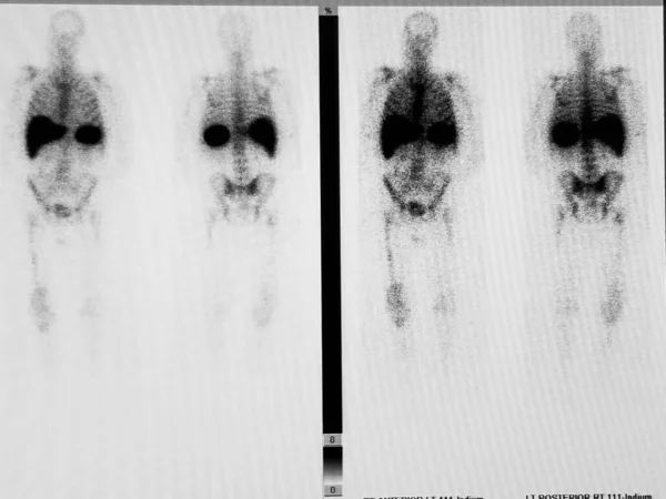 Septic Right Prosmentil Knee, Indium WBC Scan — 스톡 사진