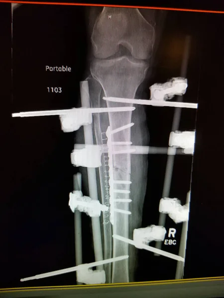 Closed Leg Fracture图库照片 免版税closed Leg Fracture图片 Depositphotos Closed Leg Fracture图库照片 免版税closed Leg Fracture图片 Depositphotos