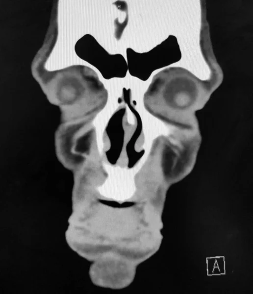 Coronale CT-scan van de sinussen en het gezicht — Stockfoto