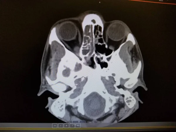 Vasculitis etmoid sinusitis - CT Scan a sinus és az arc — Stock Fotó