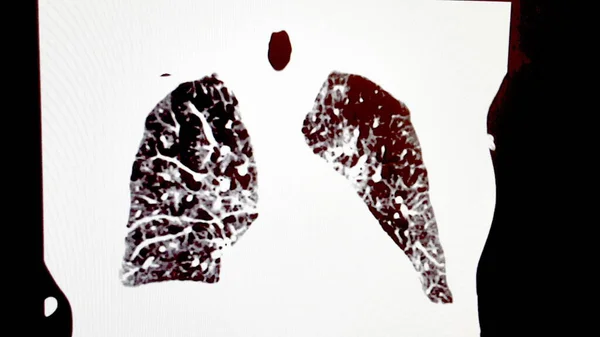 Cornonal Chest CT Scan - Coccidioides pneumoniás beteg — Stock Fotó