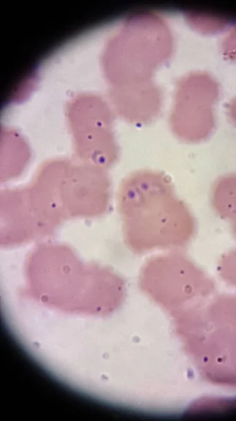 Plasmodium falciparum forme un anneau à l'intérieur des globules rouges — Photo