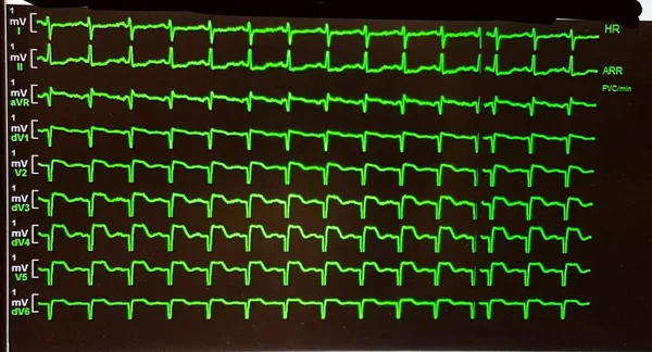 Többszörös zöld EKG követés az intenzíven — Stock Fotó