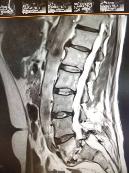 L5 - S1 Vertebral Osteomyelitis with Severe Anterolisthesis — 스톡 사진