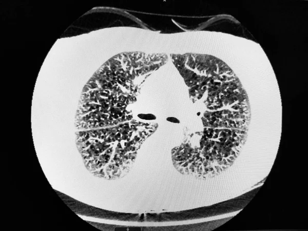 CT van de thorax vertoont ernstige COPD — Stockfoto