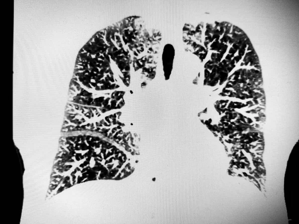 심각 한 만성 폐쇄성 폐질환을 보여 주는 흉부 CT 스톡 사진
