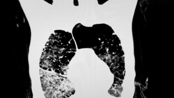 COVID-19 met Bullous Emphysema Chest CT Scan van VIdeo — Stockvideo