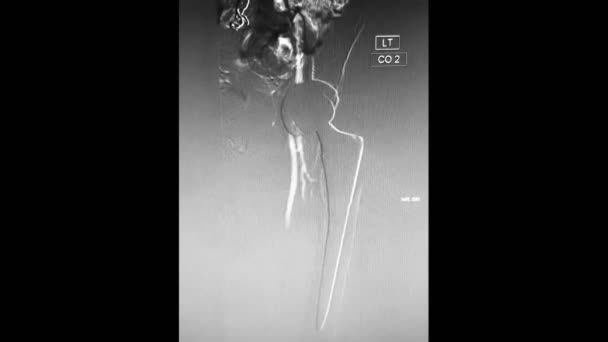 Arteriograma femoral com articulação protética do quadril esquerdo — Vídeo de Stock