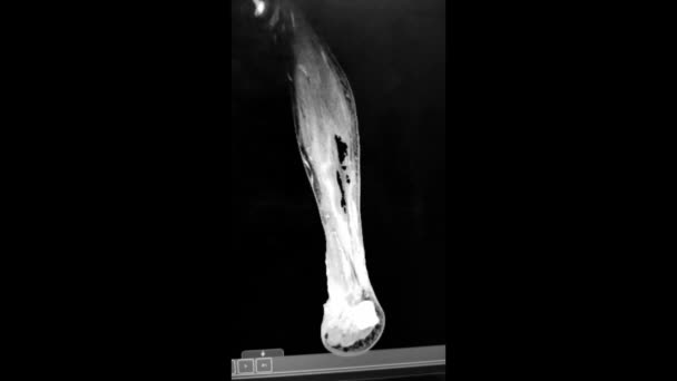 Gas Gangrene of Leg MRI HD Video — Stock video