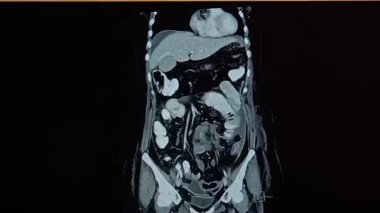 CT karın - koronal düzlemde film w iç organları