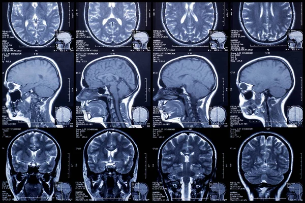 Фрагмент Мрт Мозга Диагностика Заболевания Назначение Лечения Стоковое Изображение