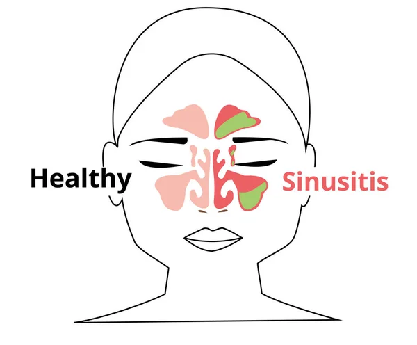 Sinusitis Orvosi Kezelés Egészséges Gyulladásos Sinus Orrbetegségek Sinusitis Sinus Fertőzés — Stock Fotó